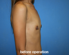 plastic-surgery-breast-augmentation